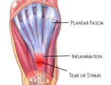 Plantar Fasciitis