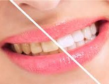 Keeping Your Teeth Nice and White
