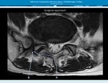 PHILIPS Direct 3D Visualization of Nerves can Influence Surgery Decisions